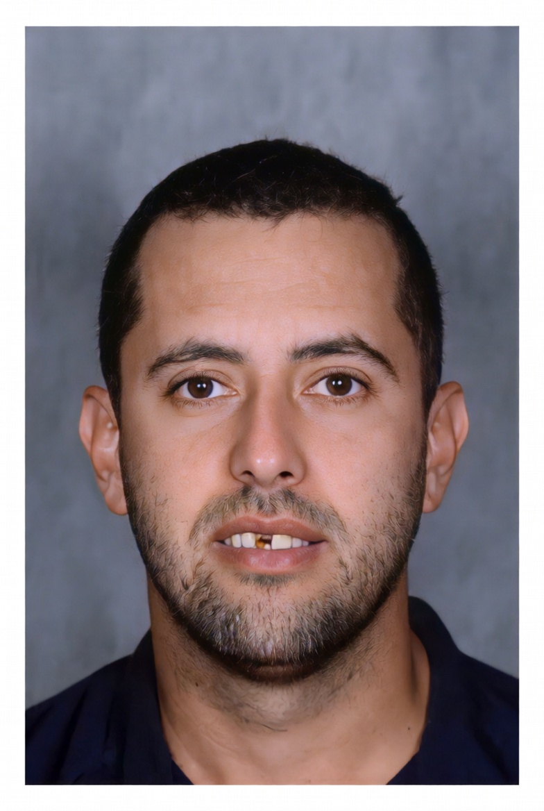 Patient 2 before cosmetic dental treatment