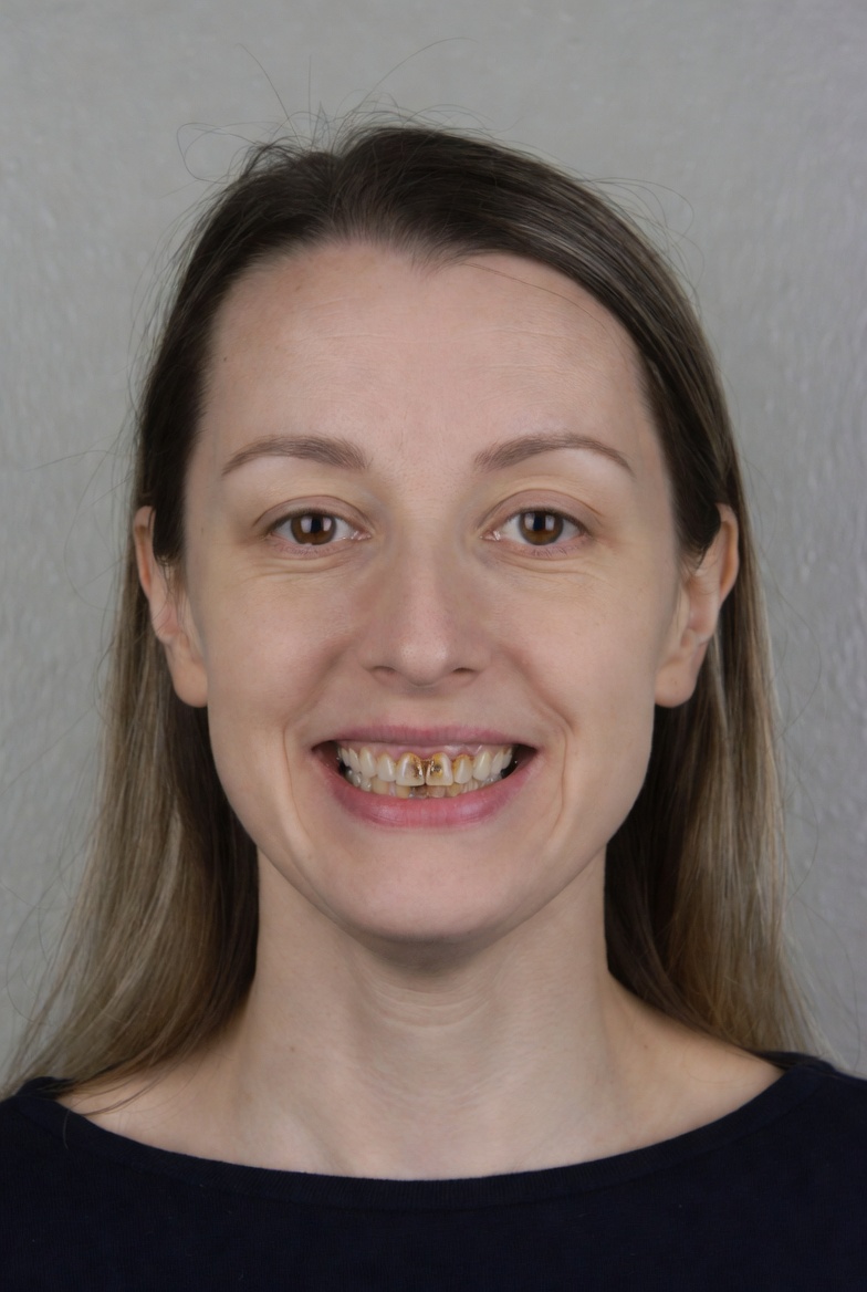 Patient 3 before cosmetic dental treatment