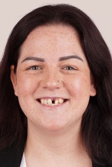 Patient 5 before cosmetic dental treatment